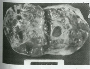 بيماريهاي تخمدان و لوله هاي رحمي چیست؟(1)